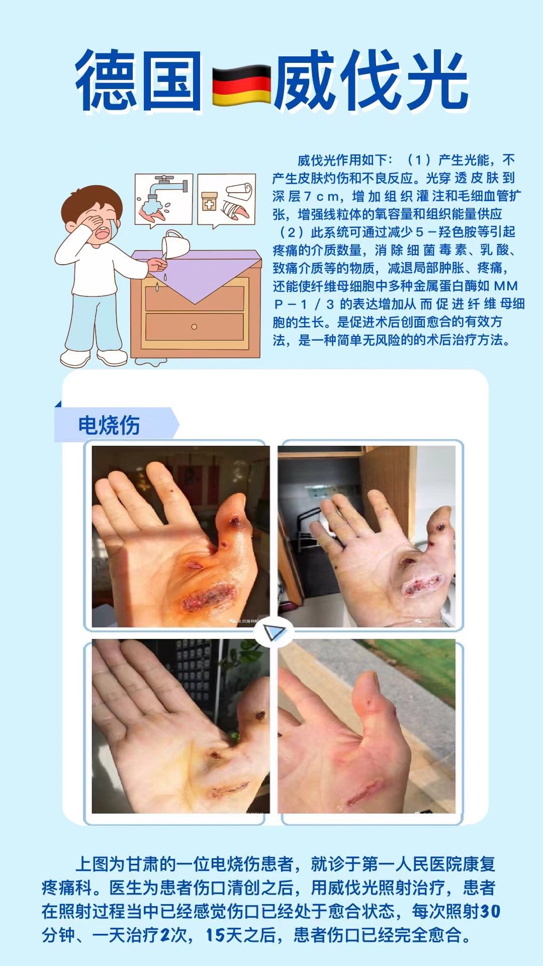 威伐光——電燒傷（20220630）